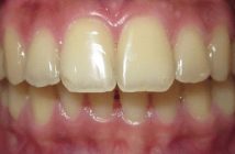 Thin Periodontal Biotype Definition Of Thin Periodontal Biotype