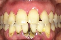 Oral Diseases Definition Of Oral Diseases