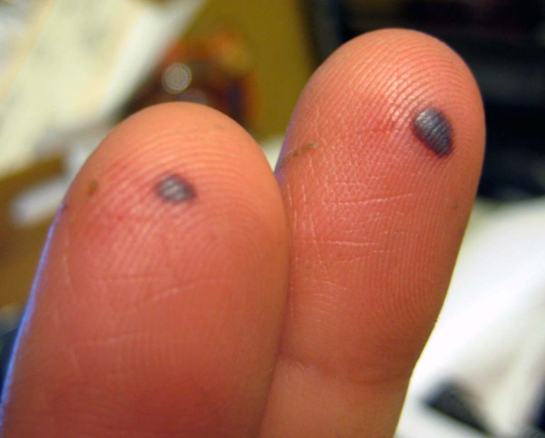 5-things-you-may-not-have-known-about-blood-blisters