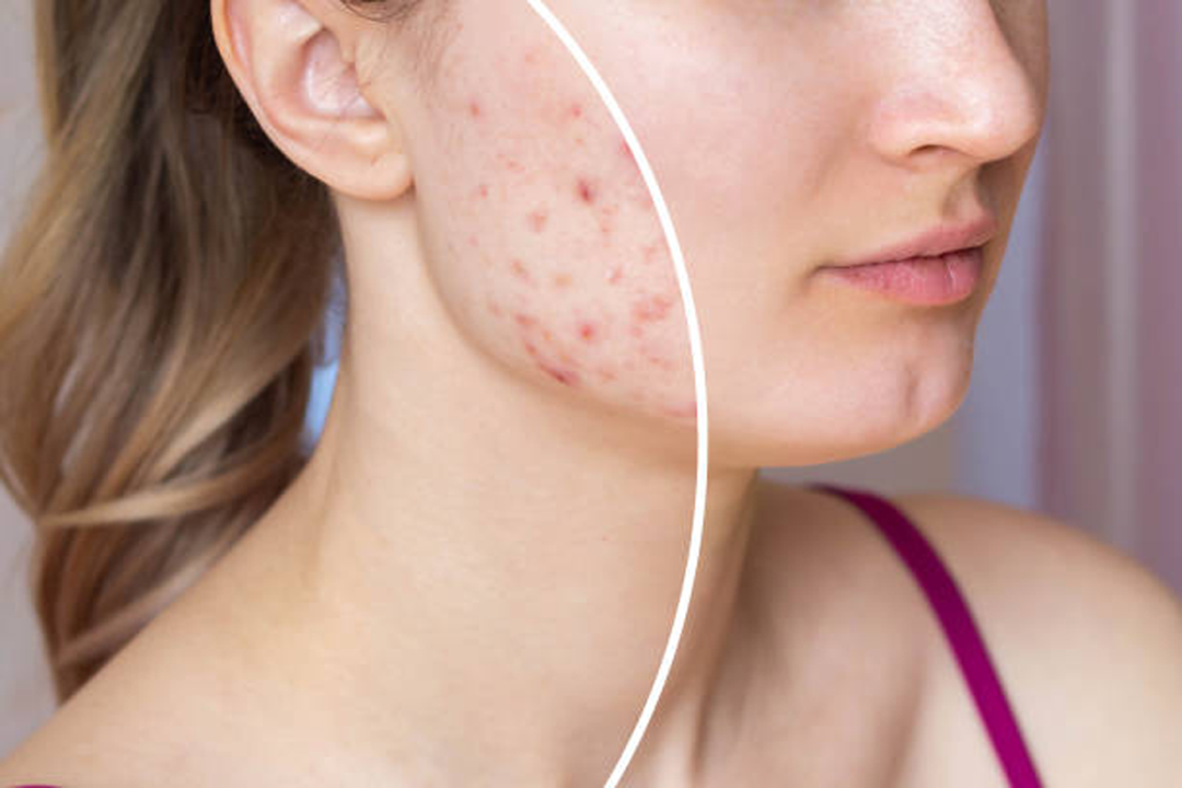 10 Vitamins And Minerals That Help Clear Up Acne