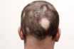 Alopecia areata