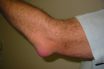 Bursitis