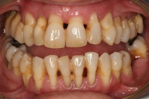 Chronic periodontitis - Definition of Chronic periodontitis