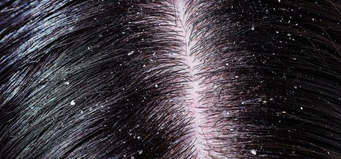 Dandruff - Definition of Dandruff