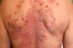 Dermatosis