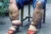 Elephantiasis