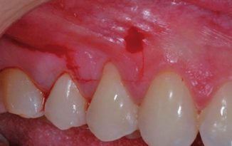 Intrasulcular incision - Definition of Intrasulcular incision