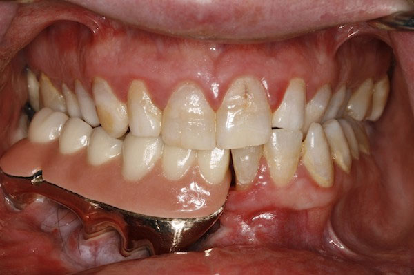 Maxillofacial Prosthetics Definition Of Maxillofacial Prosthetics