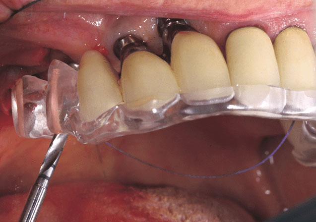 Surgical Stent Definition Of Surgical Stent