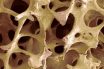 Trabecular bone