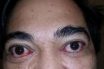 Exophthalmos or exophthalmia or proptosis