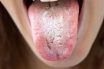 Oral thrush