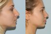 Rhinoplasty