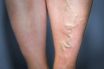 Thrombophlebitis