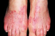 Tinea pedis - Definition of Tinea pedis