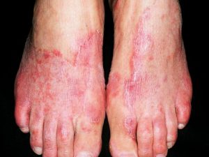 Tinea pedis - Definition of Tinea pedis