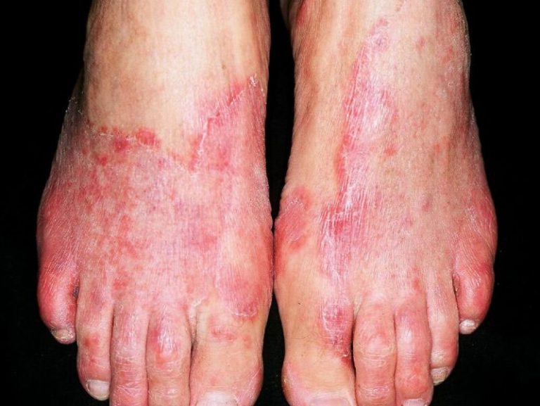 tinea-pedis-definition-of-tinea-pedis