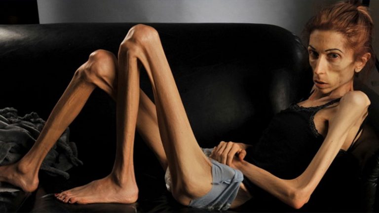 Anorexia-nervosa-768x432.jpg