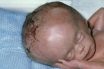 Hydrocephalus