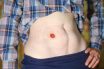 Ileostomy