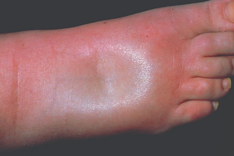 oedema-definition-of-oedema