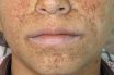 Tuberous sclerosis complex