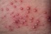 Folliculitis