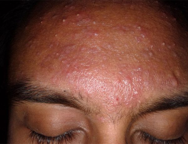 acne-definition-of-acne