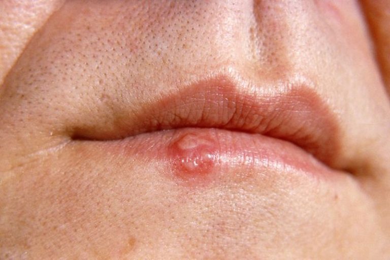 cold-sore-definition-of-cold-sore