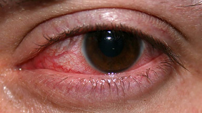 Keratitis - Definition of Keratitis