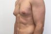 Gynecomastia