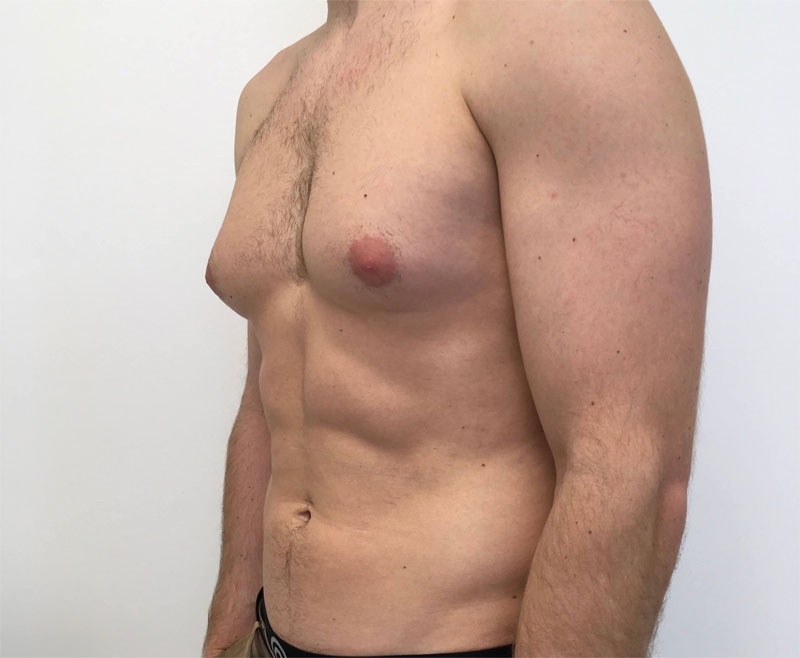 Gynecomastia Definition of Gynecomastia