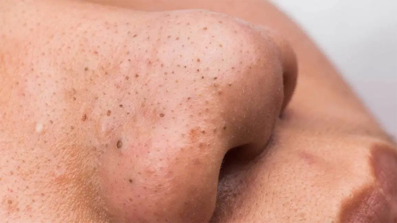 Blackhead