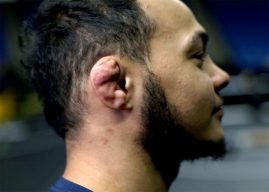 Cauliflower ear - Definition of Cauliflower ear