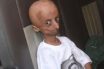 Progeria