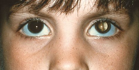 retinitis pigmentosa definition