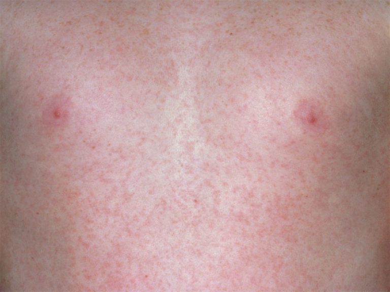 rubella-definition-of-rubella