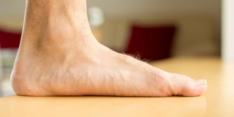 flat-foot-definition-of-flat-foot