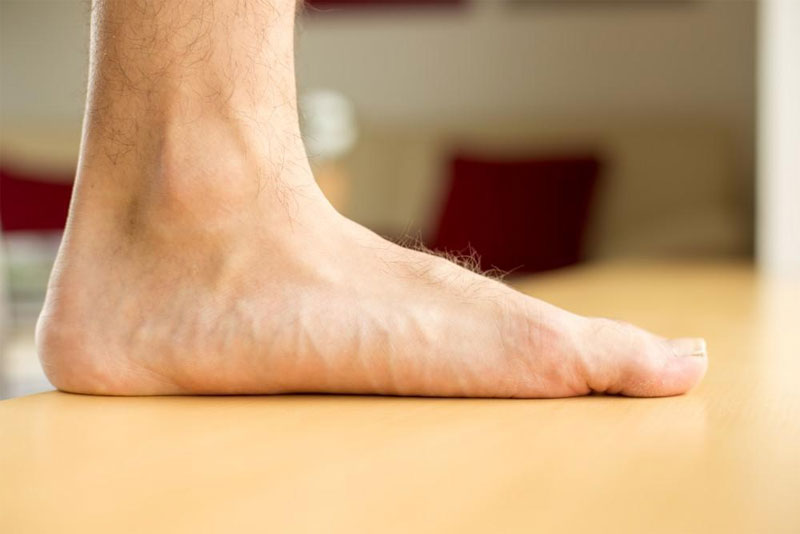 flat-foot-definition-of-flat-foot