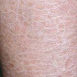 Ichthyosis Vulgaris - Definition Of Ichthyosis Vulgaris