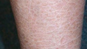 Ichthyosis vulgaris - Definition of Ichthyosis vulgaris