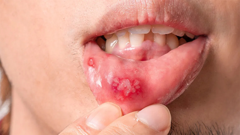 Canker sore