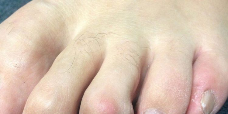 mallet-toe-definition-of-mallet-toe